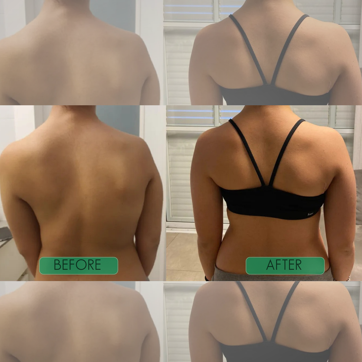 PostureAlign™ Adjustable Upper-Back Support Brace